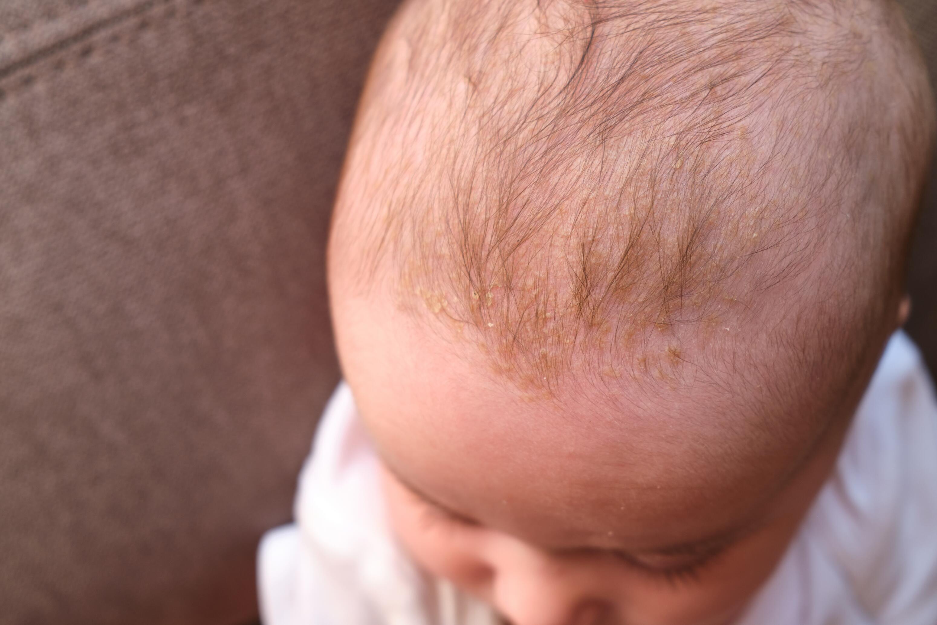 Los síntomas de la dermatitis seborreica de los bebés